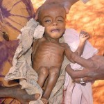 20054142 malnourished child somalia